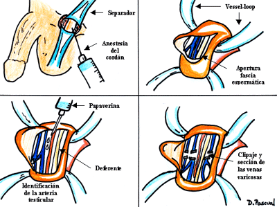 Varicocelectomía subinguinal