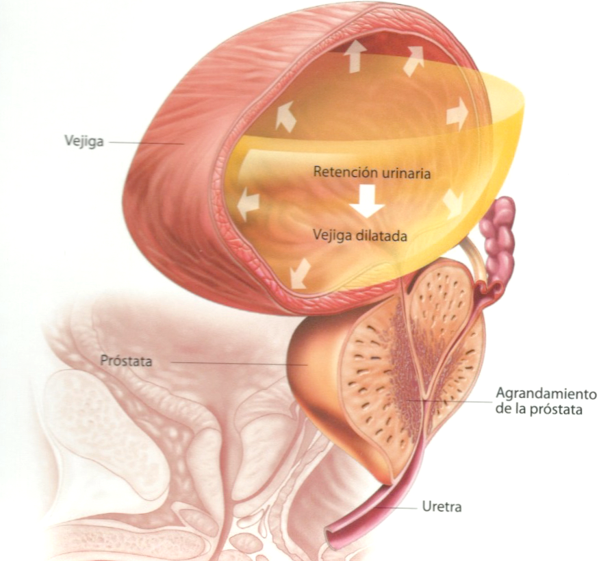 tumor prostata benigno)