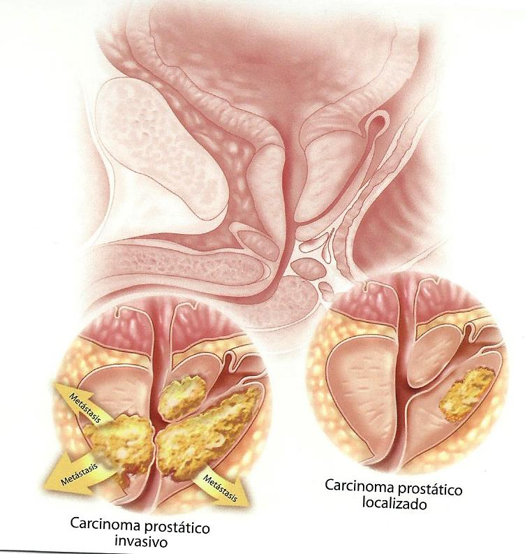 Hol a prosztata adenoma, Cancer prostata benigno