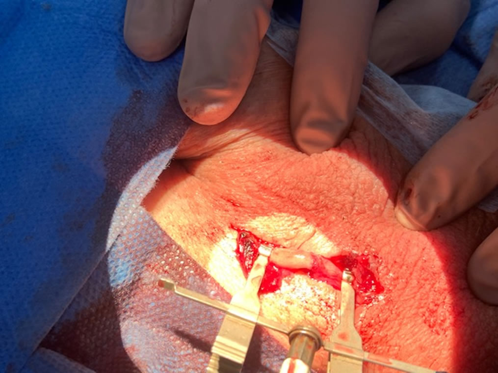 Anastomosis