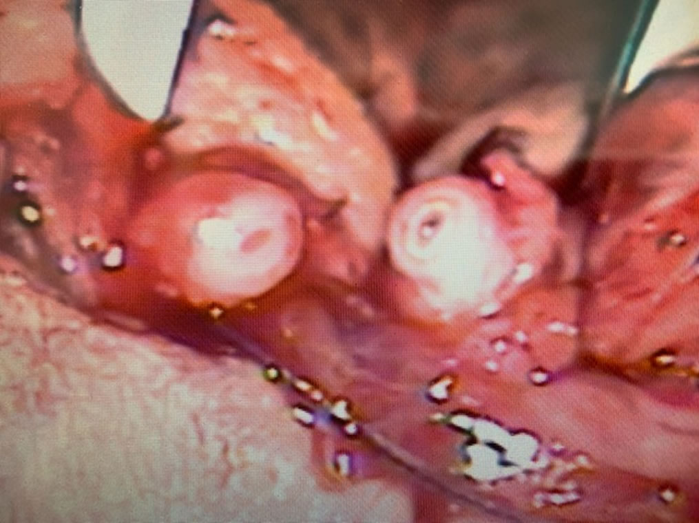 ¿Como se realiza la vaso-vasostomía?