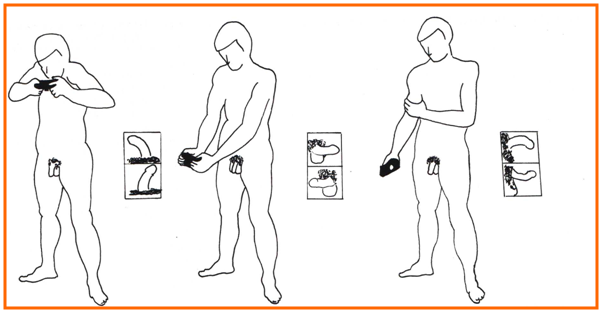 ¿Qué debo hacer si noto incurvación o un bulto en el pene?