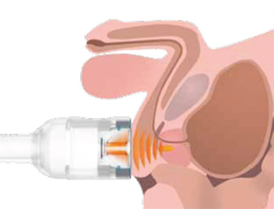 Ondas de choque en dolor pelviano