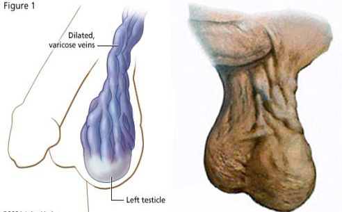 ¿Qué es el varicocele?