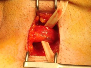 Varicocele