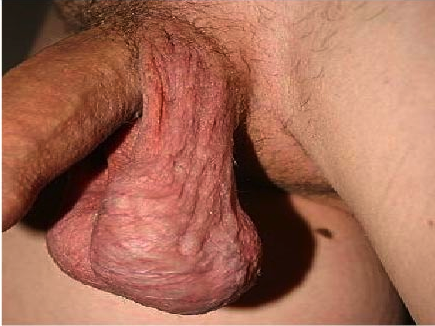 Varicocele diagnóstico