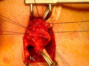 Varicocele