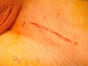 Varicocele