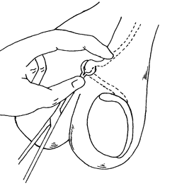 Vasectomia