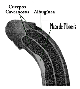 ¿En qué consiste la enfermedad de Peyronie?