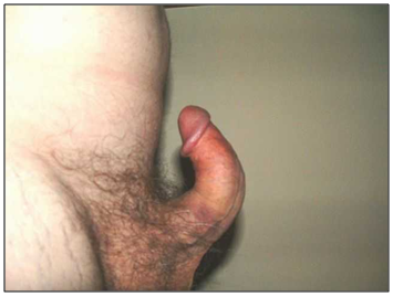 ¿Qué debo hacer si noto incurvación o un bulto en el pene?