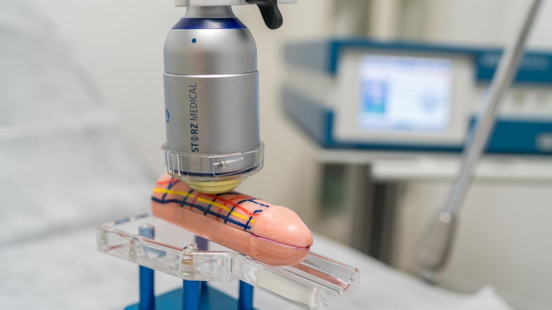 Ondas de choque para la disfunción erectil