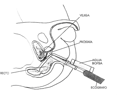 Biopsia Próstata